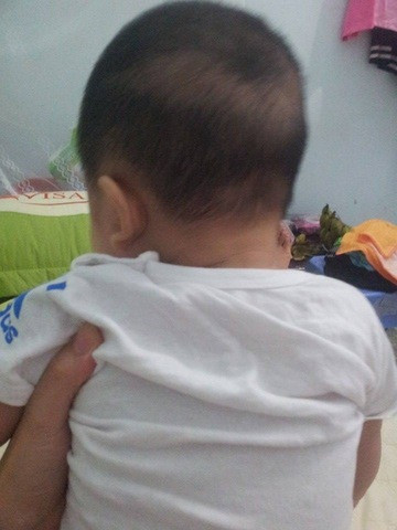 Tuy nhiên không hoàn toàn như vậy. Đôi khi bé vẫn bị rụng tóc vành khăn do phần da đầu đó cọ sát nhiều xuống gối khi nằm khiến tóc bé mọc chậm hơn.