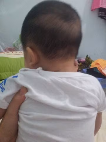 Tuy nhiên không hoàn toàn như vậy. Đôi khi bé vẫn bị rụng tóc vành khăn do phần da đầu đó cọ sát nhiều xuống gối khi nằm khiến tóc bé mọc chậm hơn.