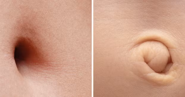  3. Rốn của mỗi người là độc nhất vô nhị: Rốn của mỗi người hoàn toàn khác nhau không chỉ bởi sự khác biệt về hình dạng bên ngoài mà còn là những thứ được chứa đựng bên trong. Đó chính là vi khuẩn. Có khoảng 2.400 loài vi khuẩn khác nhau đã được tìm thấy trong rốn con người. Và trong rốn mỗi người có chứa đựng vi khuẩn không hề giống nhau. Người ta đã từng tìm thấy loài vi khuẩn “độc quyền” tại các mẫu đất của Nhật Bản trong rốn của một người đàn ông. Điều đặc biệt là người đó… chưa đến Nhật Bản bao giờ.