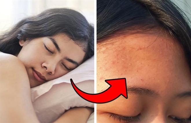 Khi bạn không thay quần áo ngủ, vi khuẩn và tế bào da chết sẽ tích tụ trong vải. Vào ban đêm, nó sẽ ép vào lỗ chân lông của bạn, bít các lỗ chân lông và gây mụn. Khi ngủ bạn hay đổ mồ hôi, đồ ngủ sẽ thấm mồ hôi và cũng làm da nổi mụn. 
