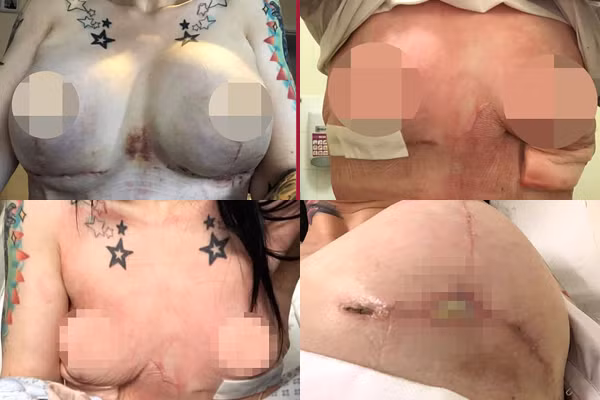 Ra nước ngoài nâng ngực, cô gái trẻ phải nạo vét cắt bỏ 2 bên vú - Hình 2 Ra nuoc ngoai nang nguc, co gai tre phai nao vet cat bo 2 ben vu-Hinh-2