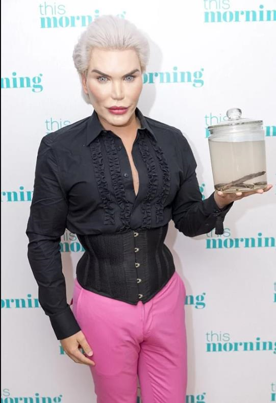 Rodrigo Alves khá tự tin khi khoe 4 chiếc xương sườn được đựng trong hộp thủy tinh sau khi được cắt bỏ khỏi cơ thể