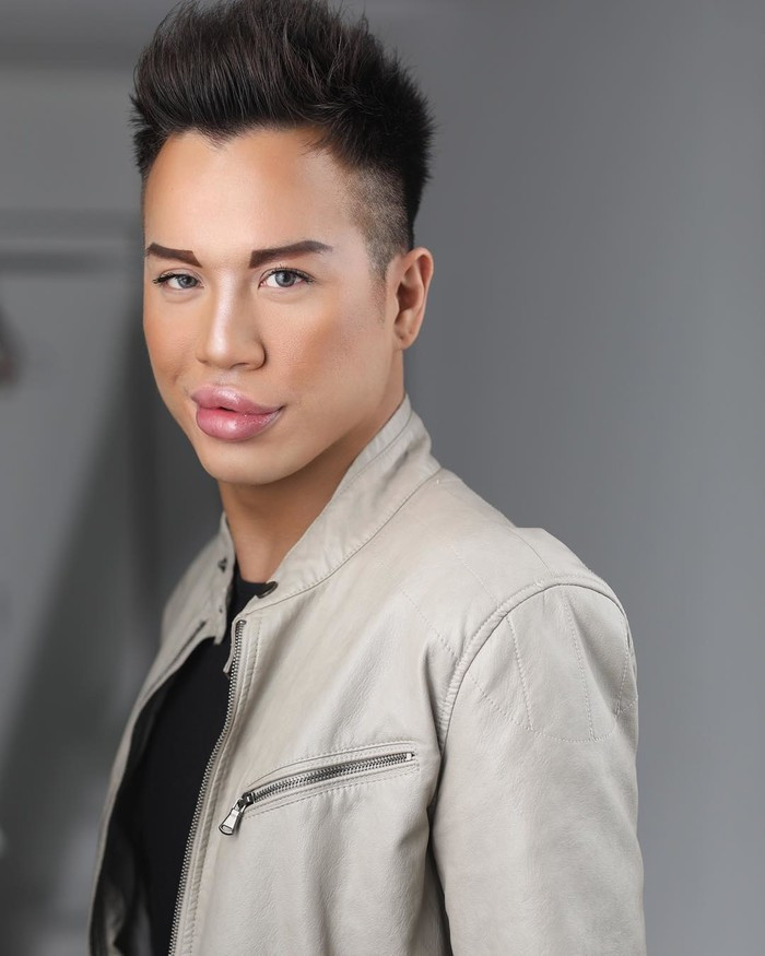 Chàng trai gây chú ý với đôi môi sưng vù đến nỗi không khép lại được miệng.