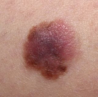 Đường kính quá lớn Một điểm đáng ngờ khi quan sát các nốt lạ trên da là đường kính của chúng lớn hơn hẳn các nốt ruồi thông thường, vốn chỉ khoảng 6mm. Khi đường kính nốt ruồi lớn hơn nốt ruồi thông thường, bạn cần đến các cơ sở khám bệnh về da ngay.