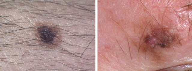 Đường viền nốt ruồi mờ Nếu như đường viền ngoài của nốt ruồi bị mờ, không thấy rõ nét đường biên giữa da và nốt ruồi, trông khác thường với các nốt ruồi khác thì đó cũng có thể là ung thư. Các thương tổn của khối u ác tính thường là nguyên nhân làm mờ các đường biên của nốt ruồi lạ trên da. Ảnh: Bên trái là nốt ruồi khỏe mạnh, bên phải là hình nốt ruồi có đường viền mờ.