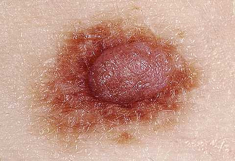  Độ lồi Nếu nốt lạ nổi lồi trên da rõ nét thì việc kiểm tra là cần thiết. Khối u ác tính thường phát triển nhanh chóng về kích cỡ hoặc độ lớn. Một nốt ruồi cứ lớn dần, đổi màu, gây ngứa ngáy, khó chịu hoặc chảy máu thực sự là dấu hiệu đáng báo động. 