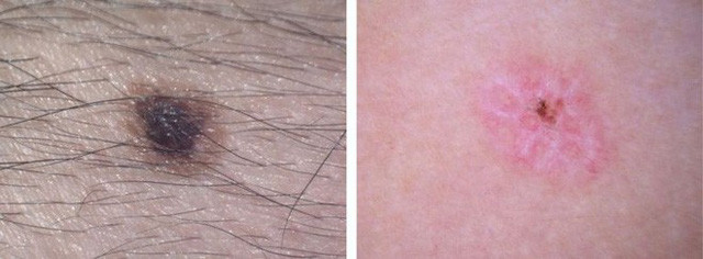  Màu sắc bất thường Nốt ruồi không có màu giống với những nốt ruồi khác trên da, dù là bất kể màu sắc gì: nâu, đen, xanh đậm, trắng hay đỏ đều đáng nghi ngờ. Nốt ruồi bình thường sẽ có một màu sắc nhất định, tương tự và đồng đều nhau trên da. Nhưng nếu trên da có nhiều nốt ruồi khác màu, khác hình dạng, khác màu: chỗ màu đậm, chỗ màu nhạt thì nguy cơ ung thư rất cao. Ảnh: Nốt ruồi bên phải màu sắc nhợt nhạt, không đều có nguy cơ gây bệnh về da 