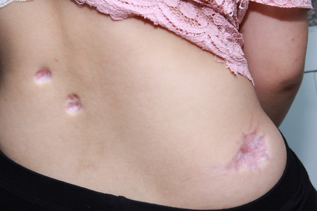 Tiem thuoc tai tham my vien o Ha Noi, seo loi thanh seo lom-Hinh-2