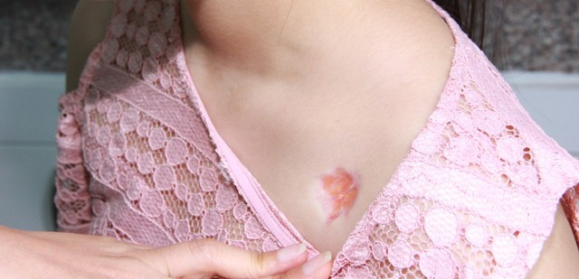 Tiem thuoc tai tham my vien o Ha Noi, seo loi thanh seo lom