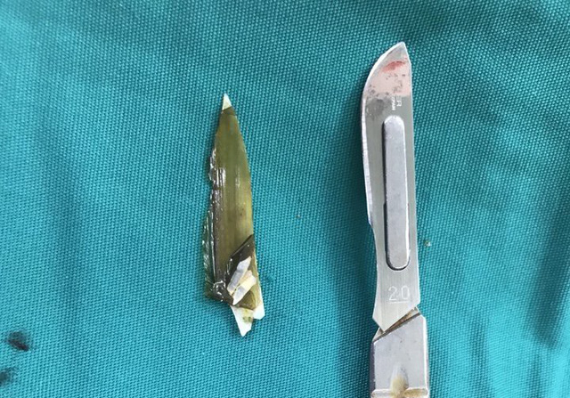 Mảnh dị vật là mảnh ốc "móng tay" lấy ra từ quai hỗng tràng của bệnh nhân. (Ảnh: Tuổi trẻ)