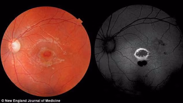 Mắt của cậu bé bị tổn thương vĩnh viễn. Ảnh: NEJM.