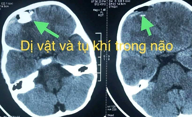 Ảnh chụp X-quang viên bi cắm vào hộp sọ bé trai. Ảnh: BVCC