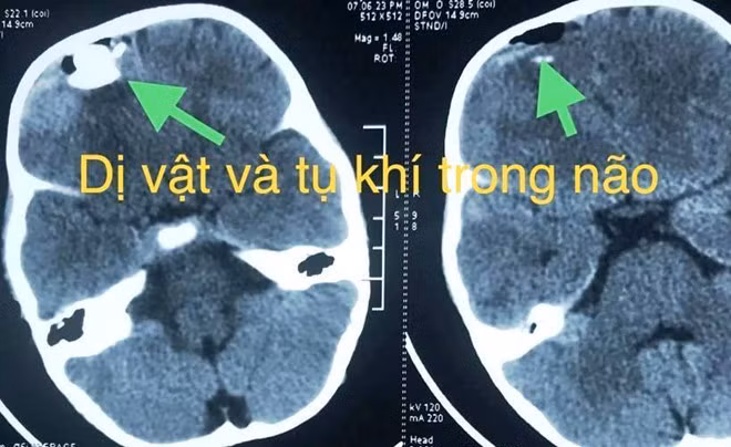 Ảnh chụp X-quang viên bi cắm vào hộp sọ bé trai. Ảnh: BVCC Ảnh chụp X-quang viên bi cắm vào hộp sọ bé trai. Ảnh: BVCC