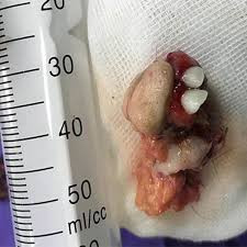 Khối u quái trong buồng trứng bé gái