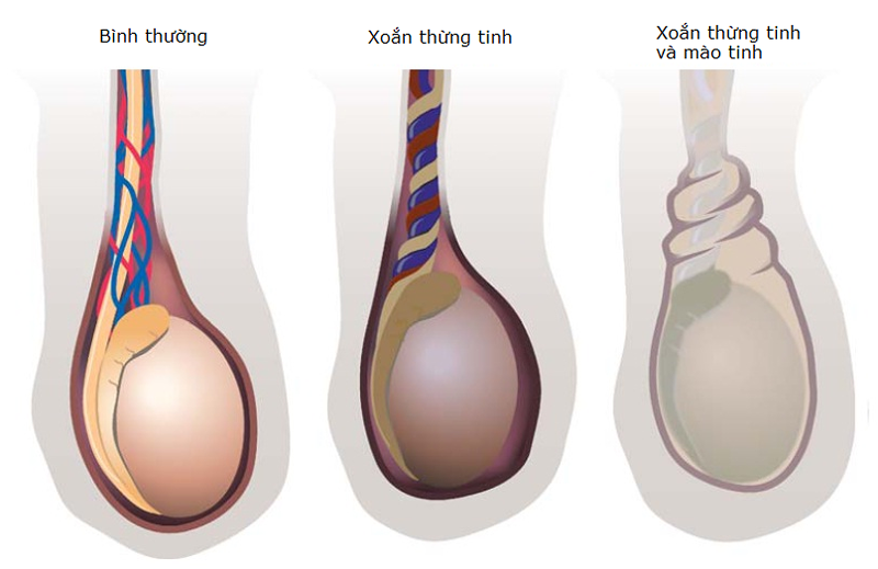 TP HCM: Bi hoai tu, be 2 ngay tuoi phai cat bo tinh hoan