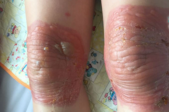 Bong nang, thoai hoa khop do bo thuoc nam chua dau khop goi