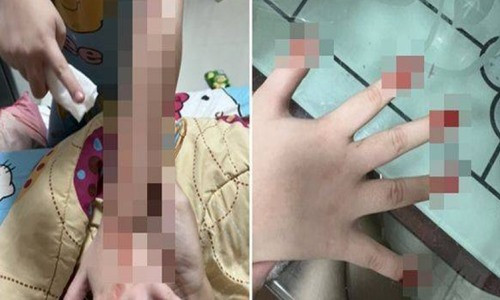 Mac benh la, he cang thang la co the tu chay mau dam dia