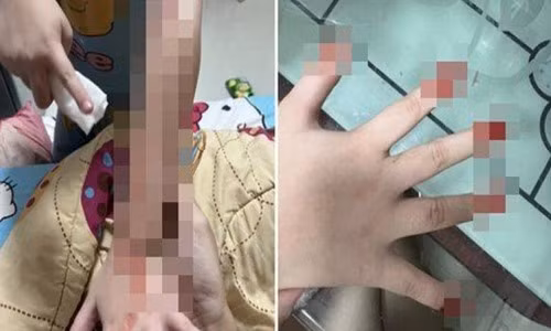 Mac benh la, he cang thang la co the tu chay mau dam dia