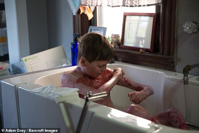 Khoảng 95% cơ thể John là vết thương hở. Đặc biệt khi tắm, làn da phải chạm vào nước khiến cậu rất đau đớn. Nhưng bất chấp nỗi đau và sự khó chịu đó, John vẫn luôn cố gắng hết mình để giúp đỡ những đứa trẻ khác cùng mắc bệnh giống mình, bằng cách nâng cao nhận thức của mọi người và tổ chức các sự kiện từ thiện.