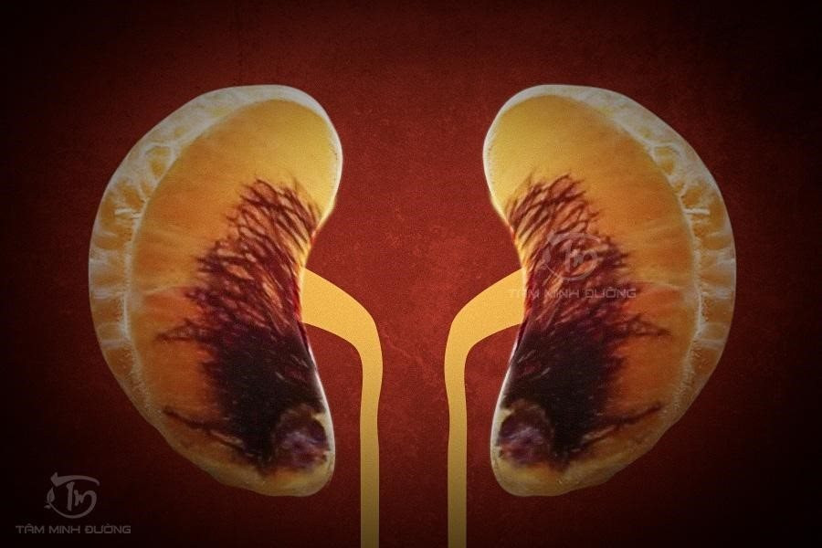 Cac bien chung suc khoe khon luong do huyet ap cao-Hinh-2