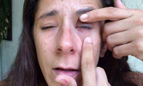 Suyt bi mu vi nham thuoc nho mat thanh keo dan