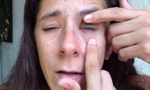 Suyt bi mu vi nham thuoc nho mat thanh keo dan