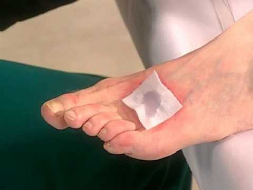 Căn bệnh này có thể gây tổn thương thần kinh ngoại vi, dẫn đến cảm giác tê dai dẳng, ngứa ran ở ngón chân. Nếu không phát hiện sớm, điều trị vết loét phải cần đến kháng sinh mạnh hoặc thậm chí phải cắt bỏ phần này.