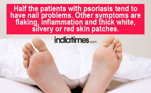 Móng chân dày, lởm chởm hoặc đổi màu cho thấy bạn mắc bệnh vảy nến. Hiện tượng móng chân rỗ báo hiệu cơ thể mắc bệnh vảy nến hoặc bệnh da mạn tính. Bệnh vảy nến ảnh hưởng 1 – 2% dân số, thường bắt nguồn do stress, lạm dụng thuốc hoặc di truyền.