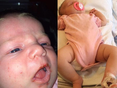 Đáng lưu ý, trong khi người trưởng thành có khả năng chịu đựng đau đớn do bệnh nguy hiểm này mang lại thì trẻ nhỏ với hệ miễn dịch yếu dễ chịu tác động nghiêm trọng, thậm chí có thể dẫn tới tử vong.