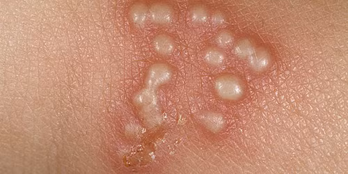 Lây truyền Herpes. Herpes là một loại bệnh mụn rộp, xuất hiện phổ biến ở các vùng như môi, mũi, má, bộ phận sinh dục và tầng sinh môn. Bệnh nguy hiểm này lây nhiễm qua 2 loại virus Herpes Simplex (HSV).