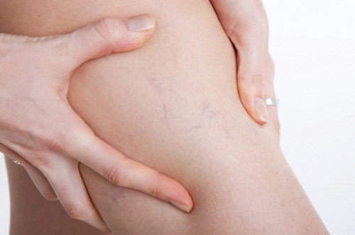 Ngồi bắt chéo chân gây suy giãn tĩnh mạch chân. Suy giãn tĩnh mạch chân (varicose vein) là thuật ngữ chỉ sự suy giảm chức năng đưa máu trở về tim từ phần chi dưới. Suy giãn tĩnh mạch chân phổ biến tới mức gần nửa dân số Mỹ đang đối diện với tình trạng này (khoảng 55% phụ nữ và 45% nam giới).