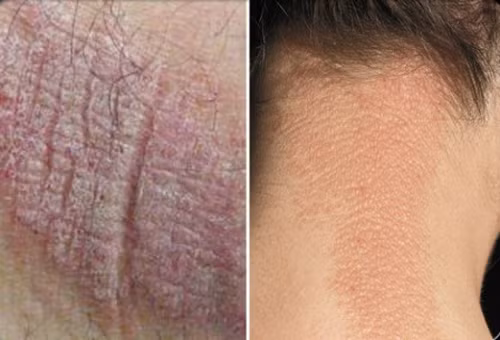 Nếu bạn có tiền sử mắc bệnh ngoài da mãn tính như sẹo lồi sau bỏng hoặc chấn thương, dị ứng… mà gần đây những dầu vết này thay đổi đột ngột, bạn cần phải đến gặp bác sĩ ngay, bởi da nổi sừng cứng, màu sắc đậm, dễ chảy máu có thể là dấu hiệu của bệnh ung thư da.