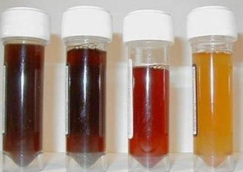 Nếu phát hiện vẩn máu trong nước tiểu kết hợp đau cạnh sườn hoặc lưng thì đó là dấu hiệu bệnh nguy hiểm tuyệt đối không nên bỏ qua. Rất có thể bạn đang đối diện với chứng sỏi thận hoặc ung thư.