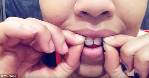 Vì vậy, họ tìm mọi cách để có được hàm răng như ý. Một trong những cách niềng răng gía rẻ phổ biến là niềng răng DIY ( niềng răng bằng dây thun tại nhà).