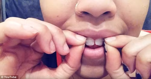 Vì vậy, họ tìm mọi cách để có được hàm răng như ý. Một trong những cách niềng răng gía rẻ phổ biến là niềng răng DIY ( niềng răng bằng dây thun tại nhà).