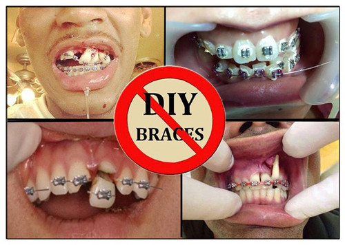 Ông Juan Rendon, bác sĩ phẫu thuật răng, thạc sĩ Khoa học Nha khoa của Phòng khám nha khoa Texas cho biết: "Nghe việc có thể di chuyển răng dễ dàng như vậy cũng thật hấp dẫn, tuy nhiên, khi răng bạn bị di chuyển, màu sắc của nó có thể bị thay đổi vì bạn đang làm tổn hại đến nguồn cung cấp máu.