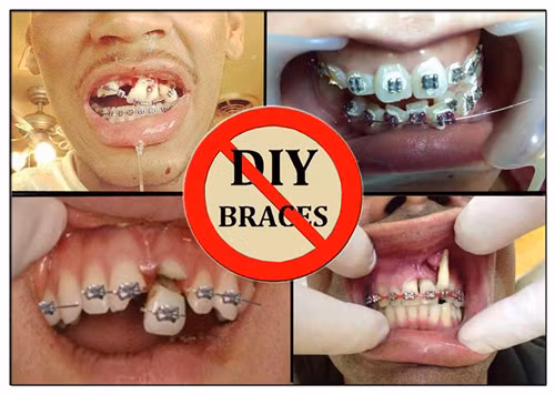 Ông Juan Rendon, bác sĩ phẫu thuật răng, thạc sĩ Khoa học Nha khoa của Phòng khám nha khoa Texas cho biết: "Nghe việc có thể di chuyển răng dễ dàng như vậy cũng thật hấp dẫn, tuy nhiên, khi răng bạn bị di chuyển, màu sắc của nó có thể bị thay đổi vì bạn đang làm tổn hại đến nguồn cung cấp máu.