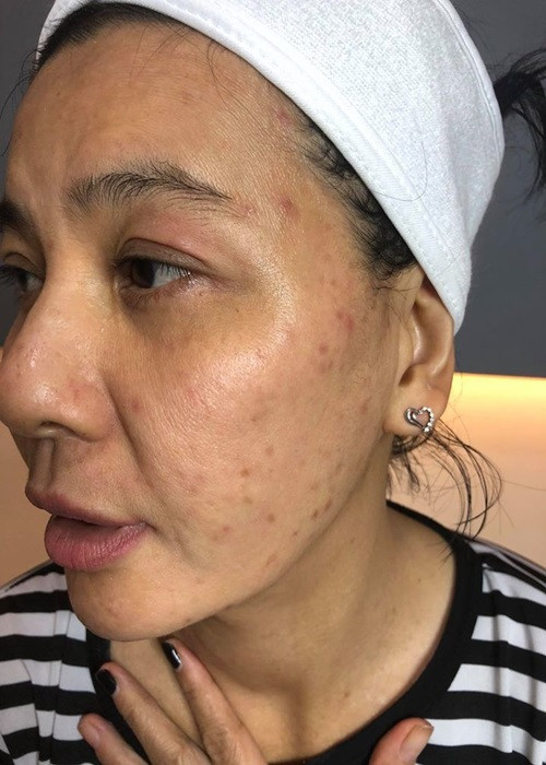 Cát Phượng từng chia sẻ gương mặt bị mụn, thâm. Ảnh: FBNV