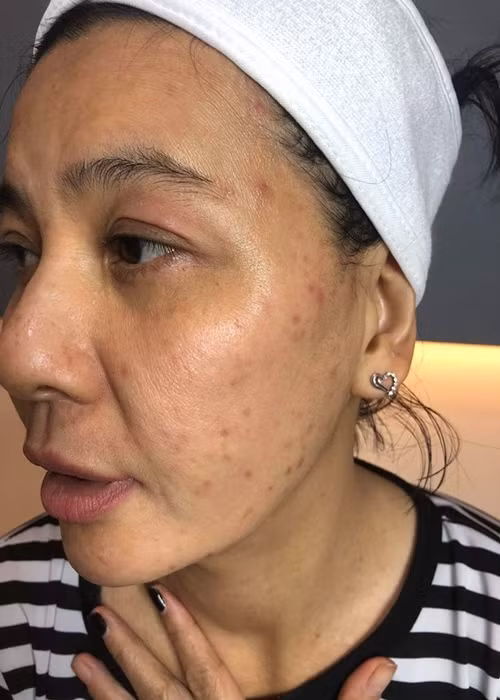 Cát Phượng từng chia sẻ gương mặt bị mụn, thâm. Ảnh: FBNV