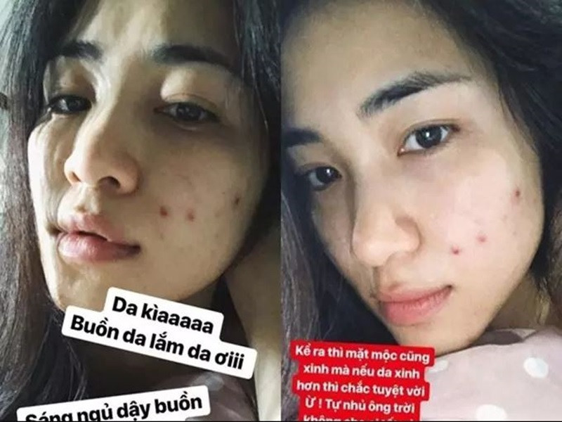 Không chỉ Cẩm Đan khổ sợ vì mụn, Hòa Minzy cũng rơi vào trường hợp tương tự. Ảnh: Vietnamnet