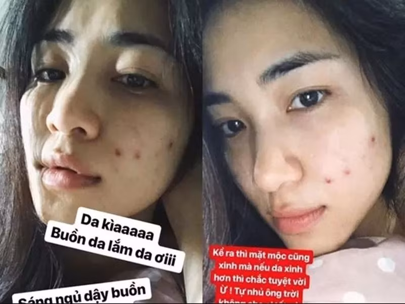 Không chỉ Cẩm Đan khổ sợ vì mụn, Hòa Minzy cũng rơi vào trường hợp tương tự. Ảnh: Vietnamnet