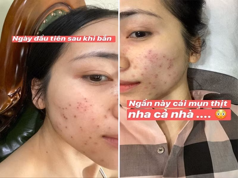 Hòa Minzy từng từ chối nhiều lời mời biểu diễn bởi không tự tin ra ngoài với khuôn mặt mụn cũng như muốn giảm thiểu việc da tiếp xúc với mỹ phẩm. Ảnh: Phụ nữ Việt Nam