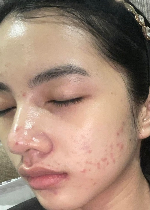 Top 15 Hoa hậu Việt Nam 2020 bị mụn "tấn công" gương mặt từ năm 2020 đến năm 2021. Ảnh: FBNV