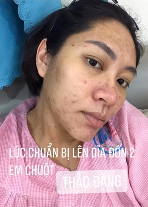 Người đẹp sinh năm 1995 không ngại ngần chia sẻ gương mặt bị mụn tàn phá khi chuẩn bị sinh hai con. Ảnh: FBNV