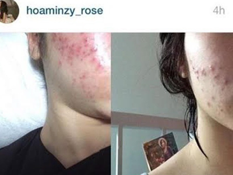 Nữ ca sĩ có làn da dễ nổi mụn, nhạy cảm. Ảnh: Phụ nữ Việt Nam