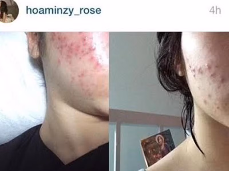 Nữ ca sĩ có làn da dễ nổi mụn, nhạy cảm. Ảnh: Phụ nữ Việt Nam