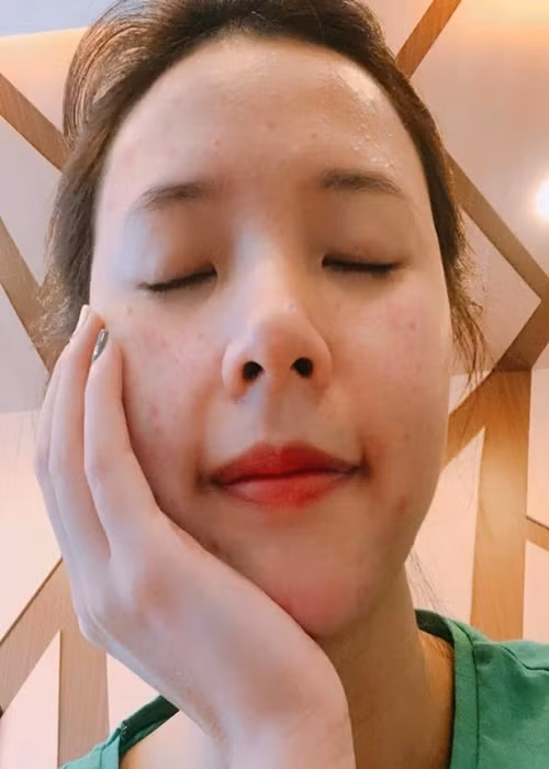 Thời điểm 2015-2016, hot girl Midu bị mất ngủ và trầm cảm nên da bị mụn rất nhiều. Ảnh: FBNV