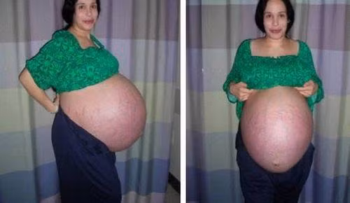 Cảnh bụng bầu khi Suleman mang thai 8 đứa con trong bụng.