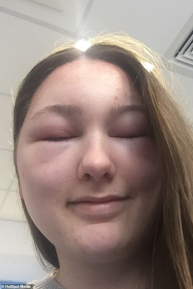 Đến cuối ngày hôm đó, vết sưng lan đến mắt và má của cô khiến khuôn mặt O'Brien sưng phồng đến nỗi cô không thể mở mắt ra. Những vảy đỏ phát triển quanh chân tóc của O'Brien bị rò rỉ mủ. Các bác sĩ cho biết đây là những vết bỏng hóa học và cô đã có phản ứng dị ứng với thuốc nhuộm tóc của mình.