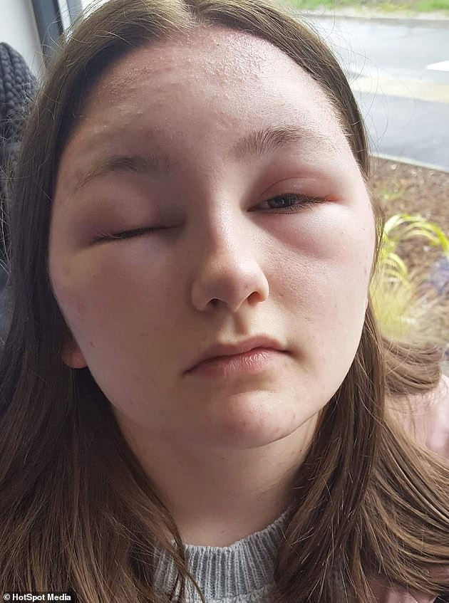 O'Brien nhuộm tóc và đi chơi đêm đó nhưng sáng hôm sau, khi tỉnh dậy cô phát hiện trán mình sưng lên gấp đôi kích thước bình thường. “Tôi hoảng hốt và nhận ra rằng tôi bị phản ứng với thuốc nhuộm tóc. Tôi đã cố gắng gội sạch thuốc nhuộm nhiều lần nhưng nó không làm giảm các triệu chứng”.